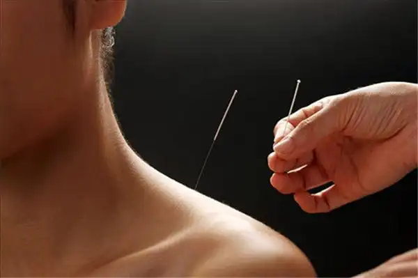 Acupuncture